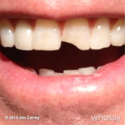 jim carrey dente rotto